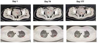 Case report: Intraabdominal infection of Mycobacterium syngnathidarum in an immunocompetent patient confirmed by whole-genome sequencing